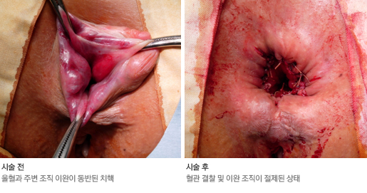 치핵 절제술 전과 후
