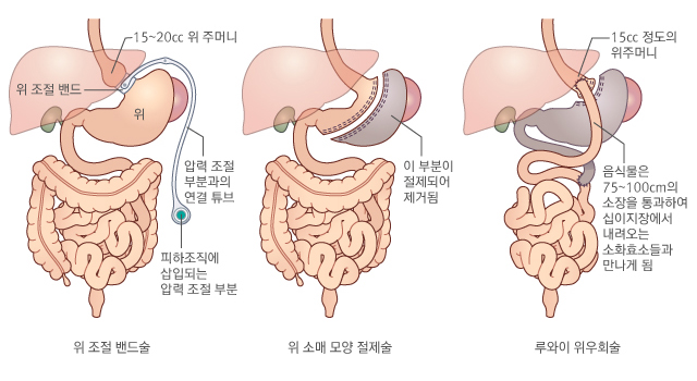 비만대사 수술 방법