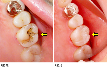 레진을 이용한 인레이 치료 전과 후