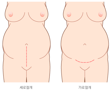 제왕절개 분만 시 피부 절개