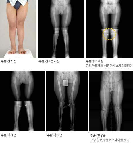13세 남아 외반슬 교정 후 경과