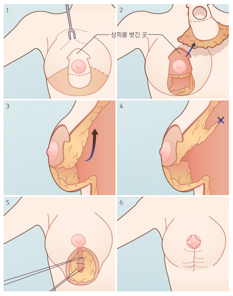 수직 흉터법을 이용한 유방 축소술