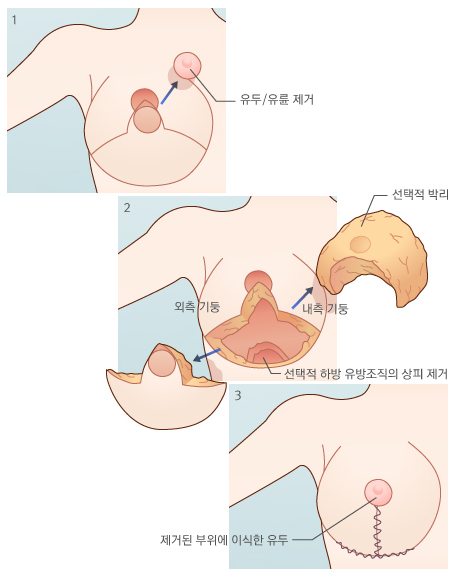 유리 유두-유륜 이식법을 이용한 유방 축소술
