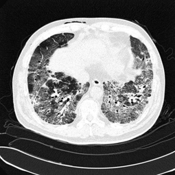말기 폐질환 CT: 폐조직이 섬유성 및 수포성으로 변함. 이산화탄소와 산소 교환기능의 장애 발생