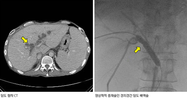 간 이식의 부작용: 담도 협착 및 담즙 누출