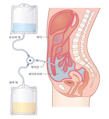 복막 투석 모식도