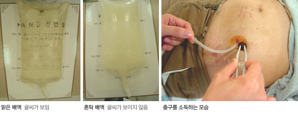 복막 투석 후 관리
