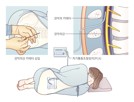 경막외강 자가통증조절장치 거치를 위한 카테터 설치
