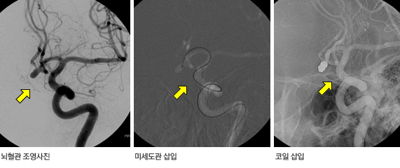 뇌동맥류 색전술 시술 과정