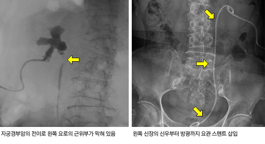 요관 스텐트 시술 전과 후