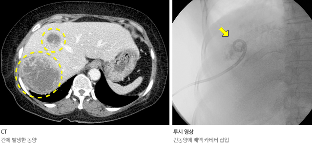 경피적 농양 배액술 시술 전과 후