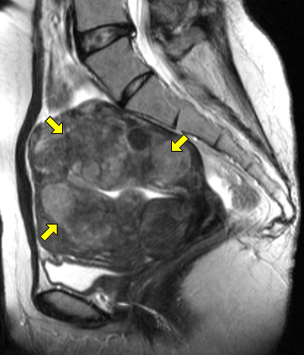 MRI 영상: 자궁 내에 여러 개의 커다란 자궁근종들이 보임