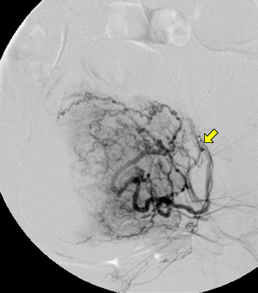 자궁근종 색전술 투시 영상: 시술 중 시행한 좌측 자궁동맥(화살표) 조영술 사진