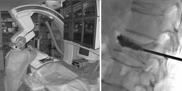 경피적 척추성형술 시술 장면(우측: 주삿바늘로 의료용 골시멘트 주입)