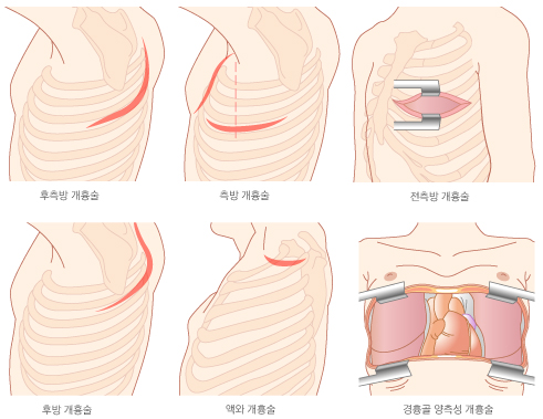 개흉술의 종류