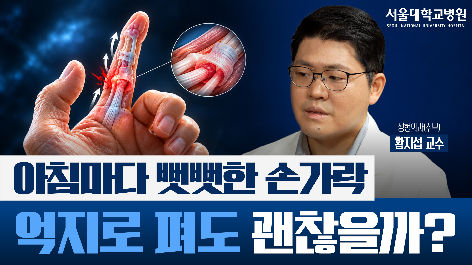 [건강 TV]손가락이 딸깍! 아침마다 굳는다면? 방아쇠 수지 증상과 치료법