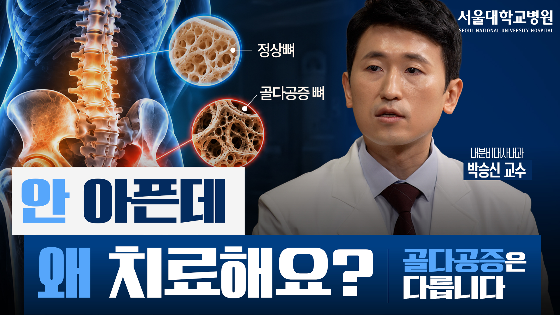 [건강 TV]골다공증, 증상 없다고 방치하면 안 되는 이유|약은 언제 시작하고 언제 끊을까?
