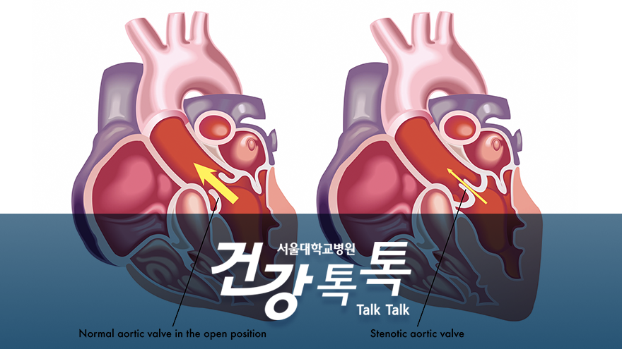 [건강톡톡][165편]대동맥판막 협착증이란?